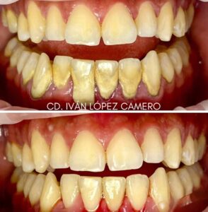 Limpieza dental4