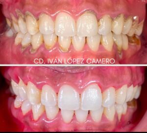 Limpieza dental3