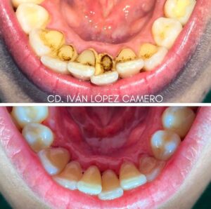 Limpieza dental2