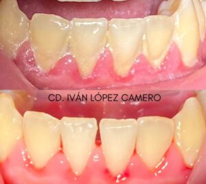 Limpieza dental5