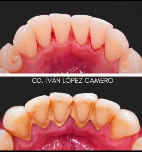 Limpieza dental1